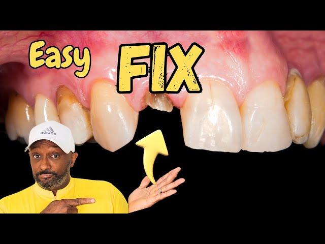 Dental Care Kit | Fix Your Cosmetic Dentistry Yourself | How To Fix A Broken Tooth