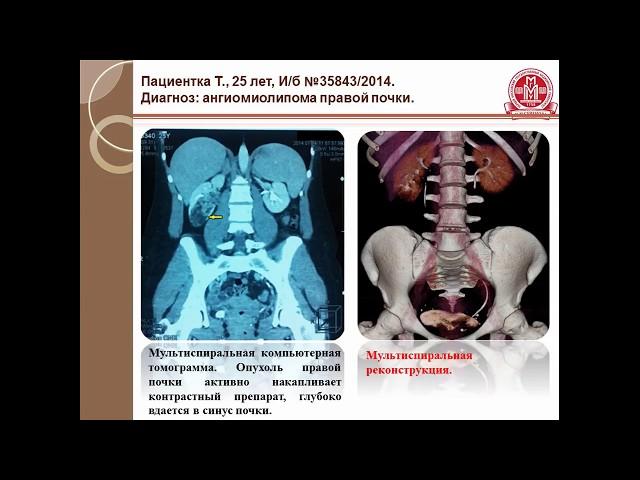 Ангиомиолипома почки. Малоинвазивные методы лечения.