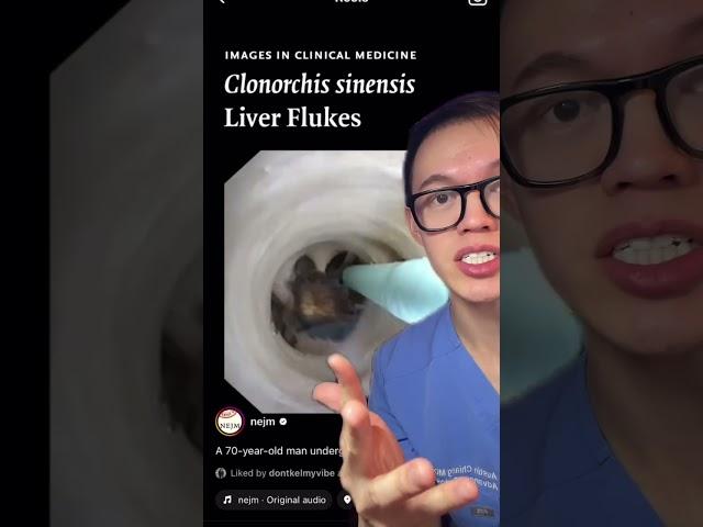  Liver critters #liverfluke #liver #parasite