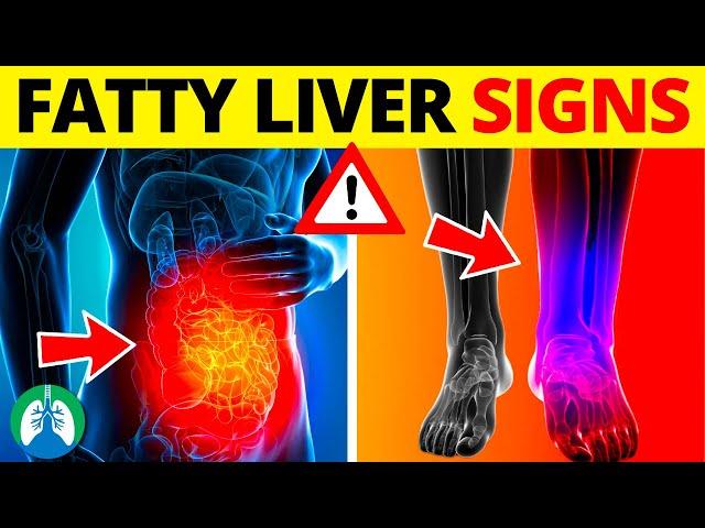  Top 10 Signs and Symptoms of Fatty Liver You MUST AVOID