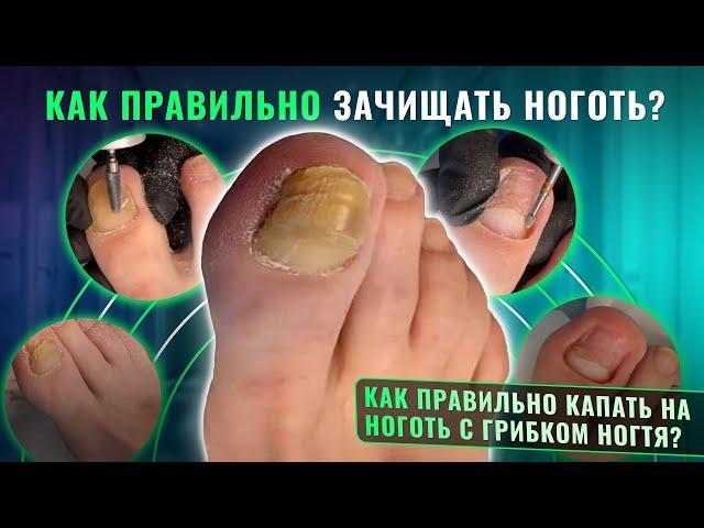 Как правильно зачищать ноготь? Как правильно капать на ноготь с грибком ногтя?