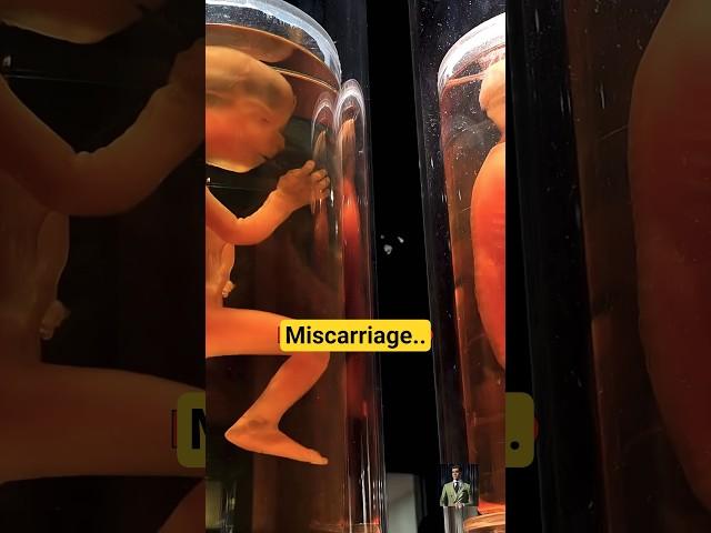 Why Miscarriage Happens: The Truth No One Talks About#miscarriages #medicalanimation | by DrLi‍️