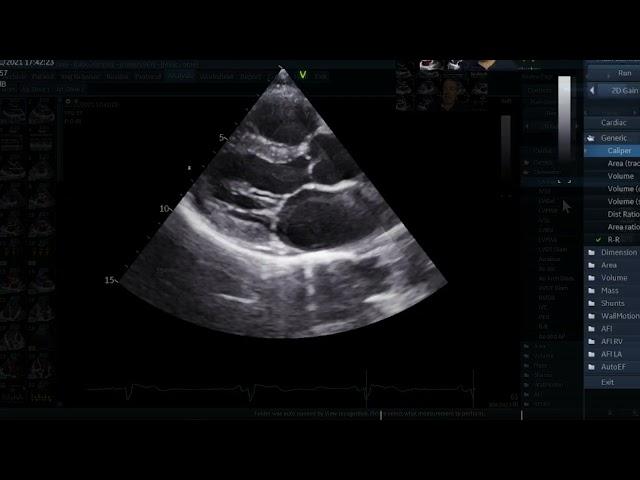 Transthoracic Echocardiography (TTE) - A Standard Examination