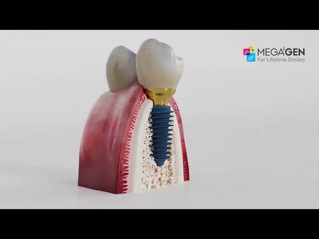 Імплантація зубів Megagen Anyridge Dental Implant