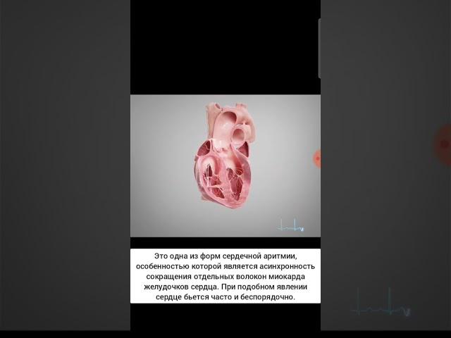Желудочковая тахикардия