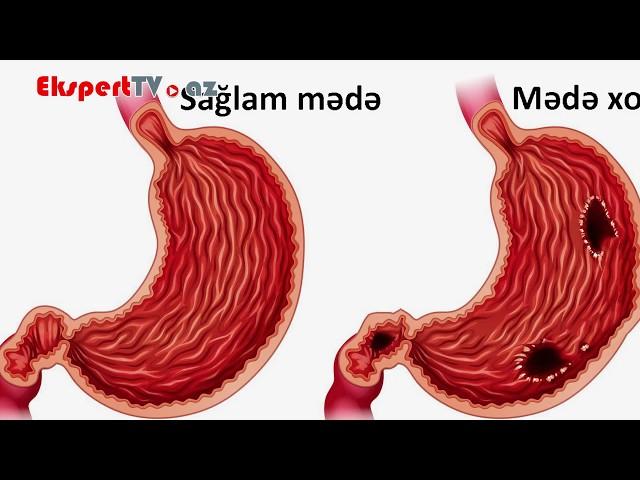 Mədə xorası olan xəstələr nələrə diqqət etməlidirlər?