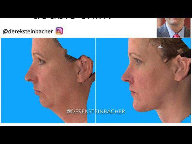 How to get rid of your double chin. Facelift necklift jaw surgery genioplasty kybella fat liposuct