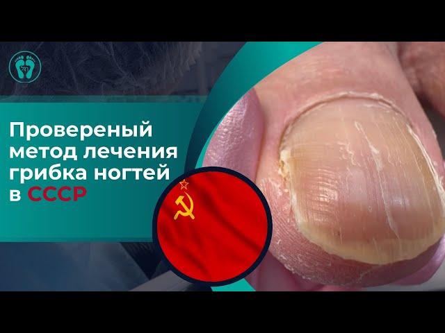 Проверенный метод лечения грибка ногтей в СССР! Никто не ожидал такого!