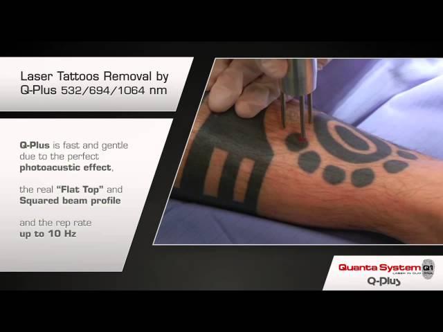 Tattoo Removal with the Q PLUS