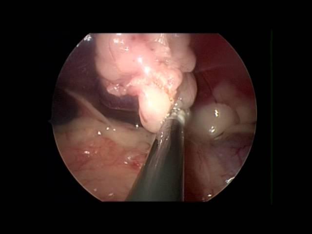 Spleen removal in a Dog Minimally Invasive Dr. Jeffrey j Runge DVM DACVS PennVET