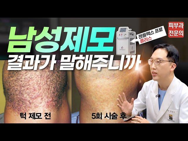 레이저 수염 제모 | 많은 남성들의 pick 젠틀맥스프로 플러스 파헤치기! + 제모 Q&A