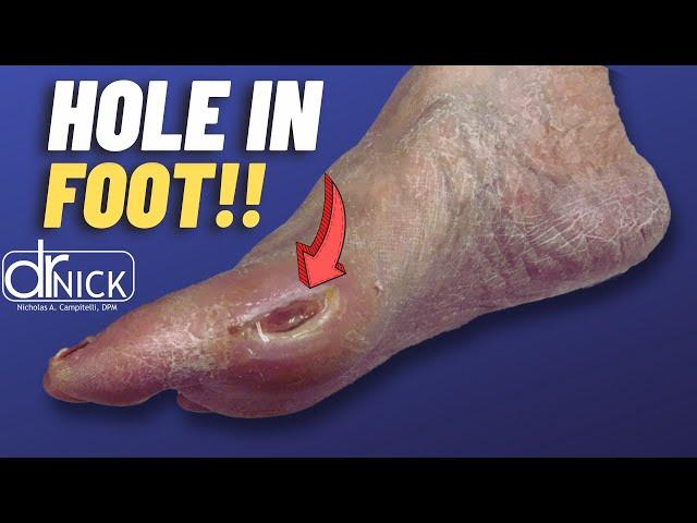 Repairing a Big Toe Ulcer | Dr Nick Campitelli