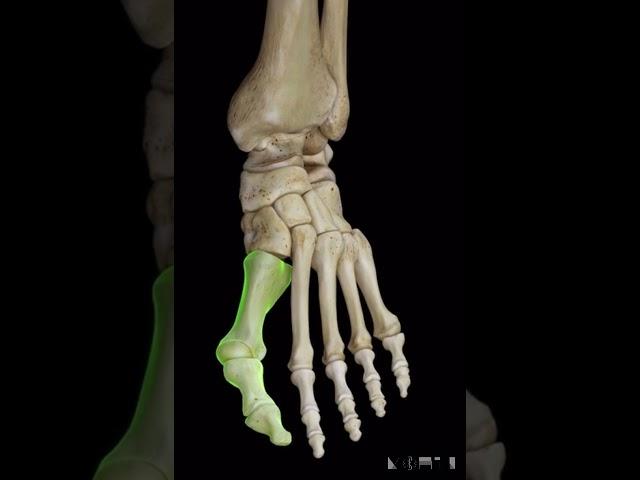 Hallux Valgus (bunion) !!! انحراف شست پا یا بونیون