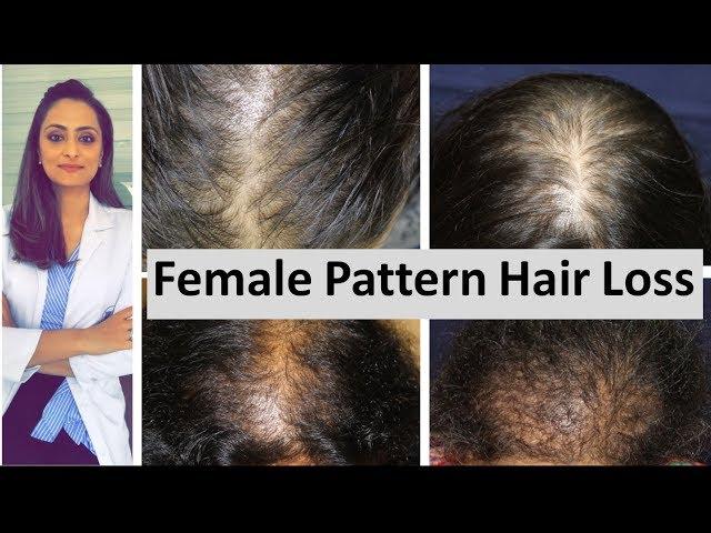 Hair loss in women | Female Pattern Hair Loss | causes & treatment | Dermatologist