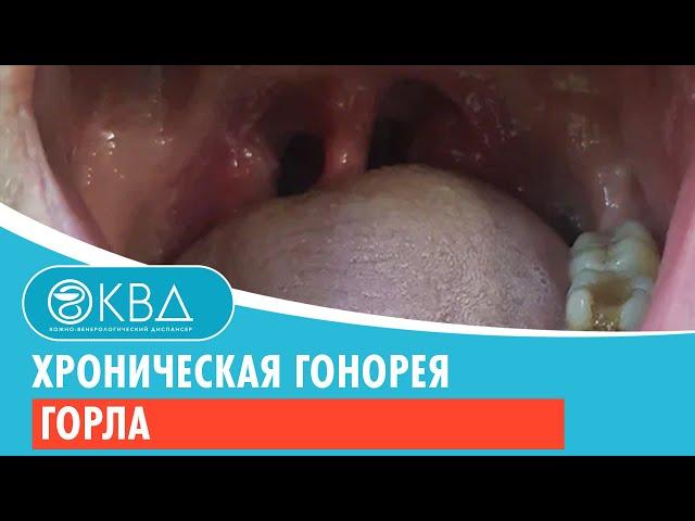  Хроническая гонорея горла. Клинический случай №811