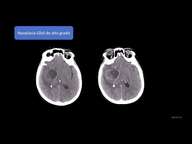 Radiología en 5 minutos: Neoplasia Glial de Alto Grado.