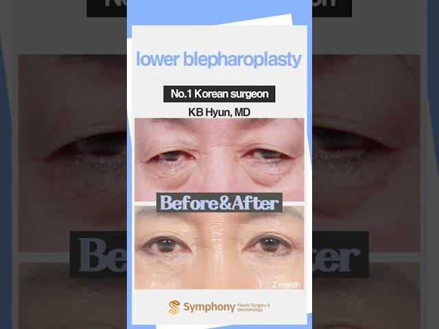 Korean lower blepharoplasty from Symphony Plastic Surgery Korea #shorts