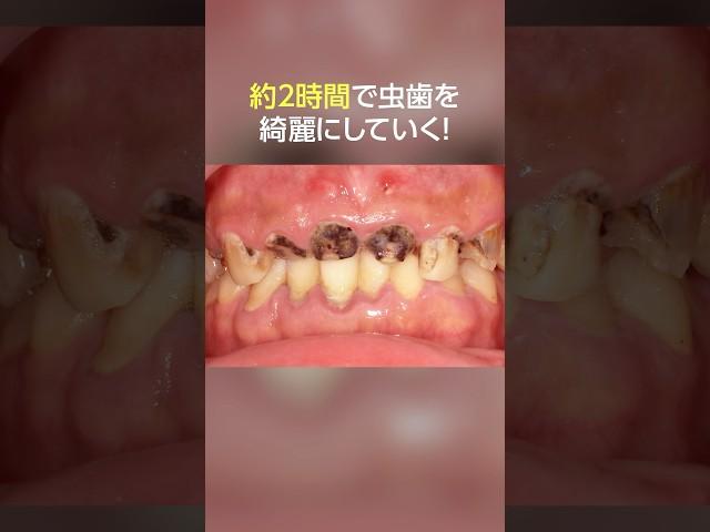 【必見‼️】約２時間で虫歯を綺麗に‼️#歯医者#dentist #ザホワイトデンタルクリニック#虫歯