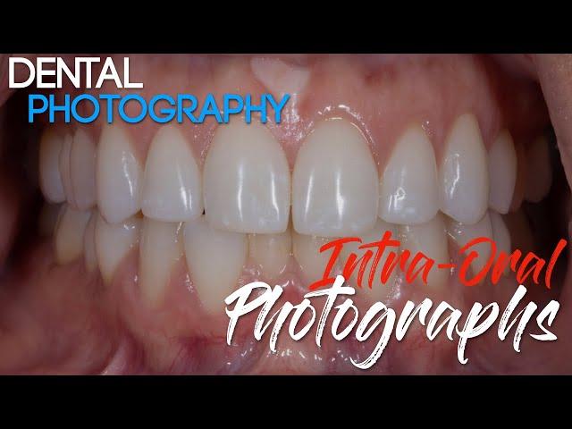 Dental Photography Basics - Dental Photography Techniques - Intra-oral Photographs