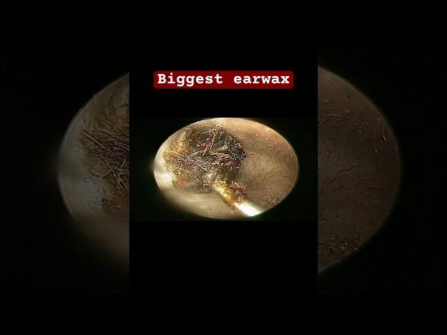 Biggest ear wax removal #earwaxremoval #earcleaning #doctoranh