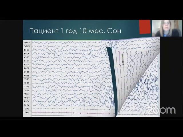 Физиологические ритмы и паттерны ЭЭГ у детей в возрасте от 1 мес до 7 лет. Романова АВ., Москва