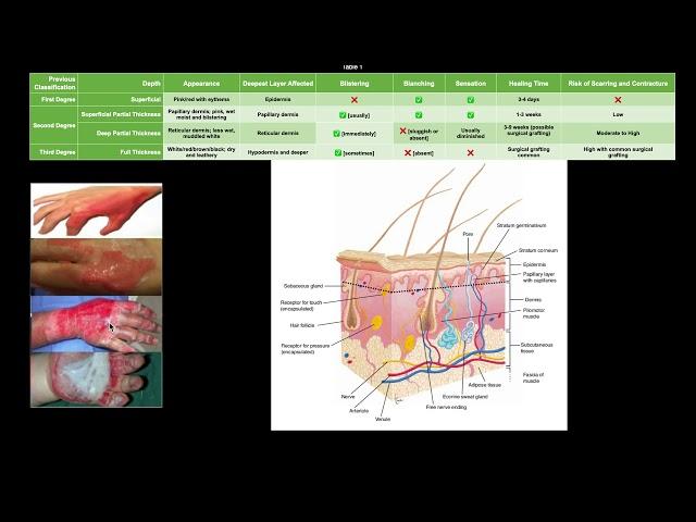 Classifying Burns EXPLAINED