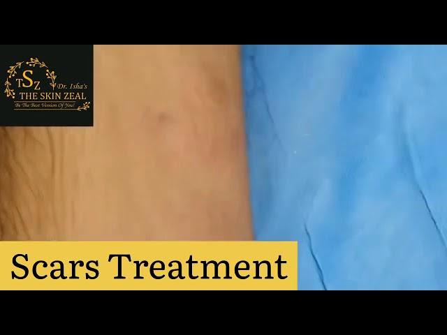 Scars treatment in zirakpur | The Skin Zeal | 72-93-93-93-26