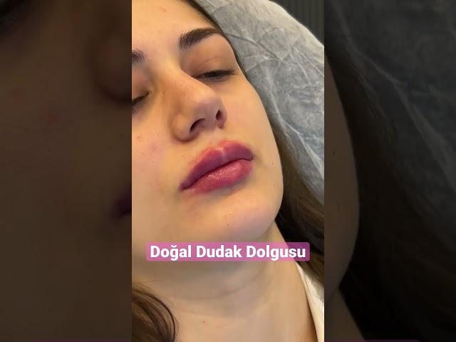 Doğal Dudak Dolgusu #dudakdolgusu #estetik