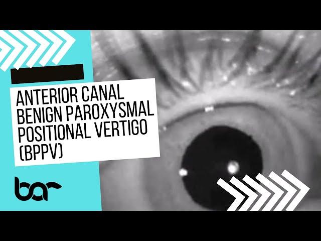 Anterior Canal BPPV blog video