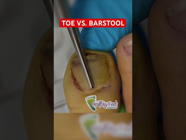 TOE versus Barstool #podiatry #popping
