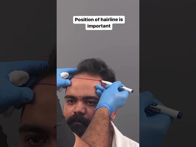 "Achieving a Natural-Looking Hairline: Expert Tips and Techniques #hairtransplant