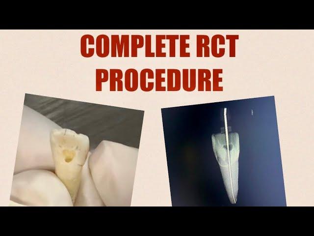 COMPLETE RCT PROCEDURE| Stepwise tutorial of RCT from Access cavity to Obturation