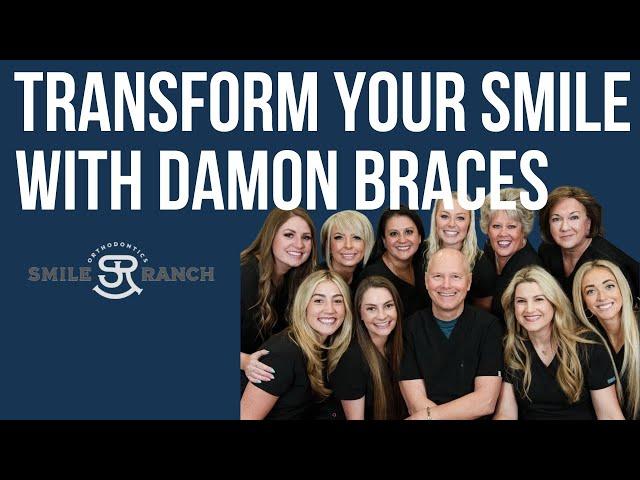 Damon Braces