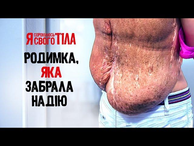 Невус, який розділив життя на ДО та ПІСЛЯ – Я соромлюсь свого тіла | МЕДИЦИНА | ЛІКАРІ | ЗДОРОВ’Я