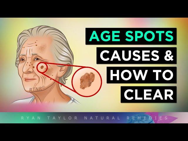 The Real Causes of AGING SPOTS