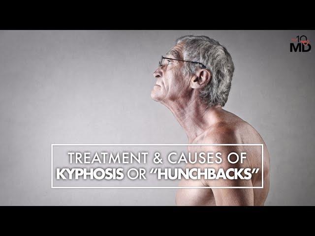 Treatment and Causes of Kyphosis or "Hunchback" | Dr. Mark Valente | Top10MD