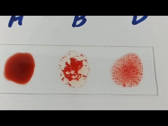 how to perform blood group||blood group|| ABO blood grouping||B positive blood group||