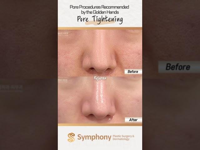 Best Pore Tightening Procedure in Korea? [Before and Afterp