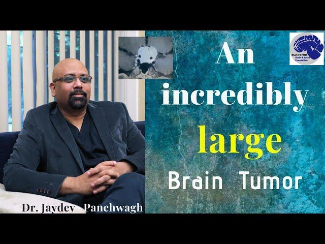 #6.Brain Tumors-Incredibly large and in critical locations. Dr Jayadev Panchwagh