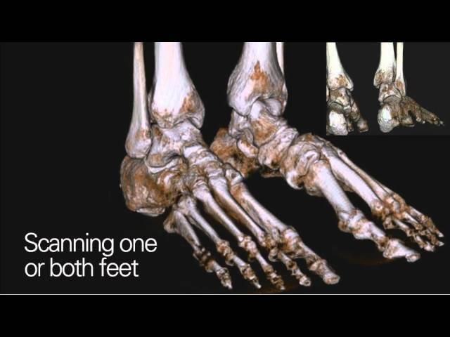 CurveBeam pedCAT: TRUE in-office weight bearing CT imaging