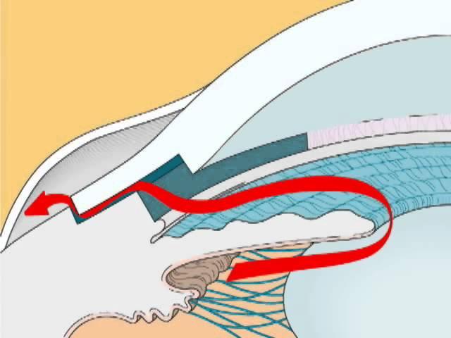 Normal Aqueous Drainage + Open-Angle Glaucoma + Glaucoma Filtering Surgery + Angle-Closure Glaucoma