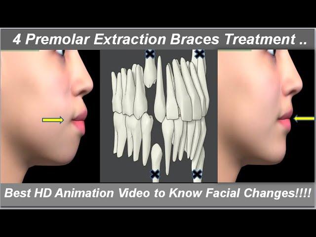 Changes in Face After 4 1st Premolars' Extraction & Braces Treatment. Best HD Animation @ Dr Ram MDS