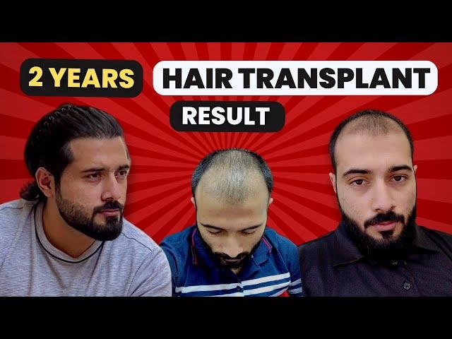 My 2 Years Turkey Hair Transplant Result & Review | Best Shampoo For Hair Loss