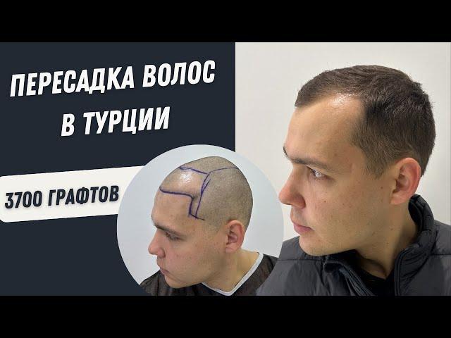 Пересадка волос в Турции | Пересадка волос 4000 графтов | Пересадка волос в Турции