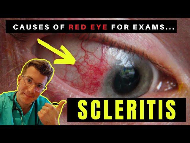 Causes of Red Eye - Part 3: SCLERITIS