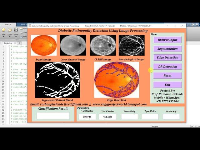 Diabetic Retinopathy Detection Using Image Processing | Matlab Project Source Code