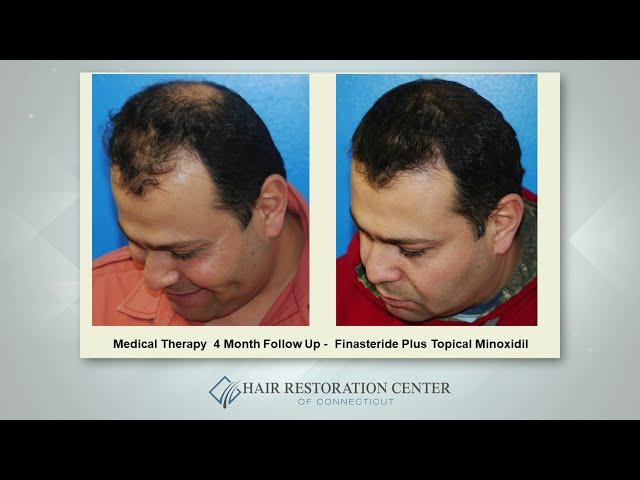 Medical Therapy Solutions For Hair Loss - Scott Boden, MD