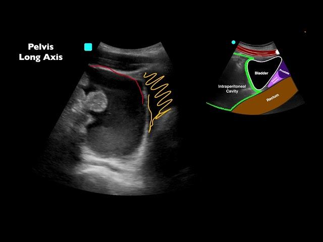 POCUS: Positive E-FAST after MVC - Can you identify all of the findings?