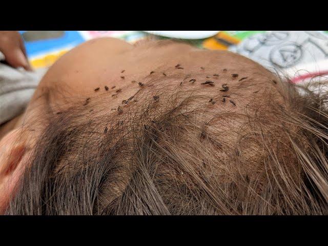 How to remove head lice from short hair - Taking out all hundred lice from hair