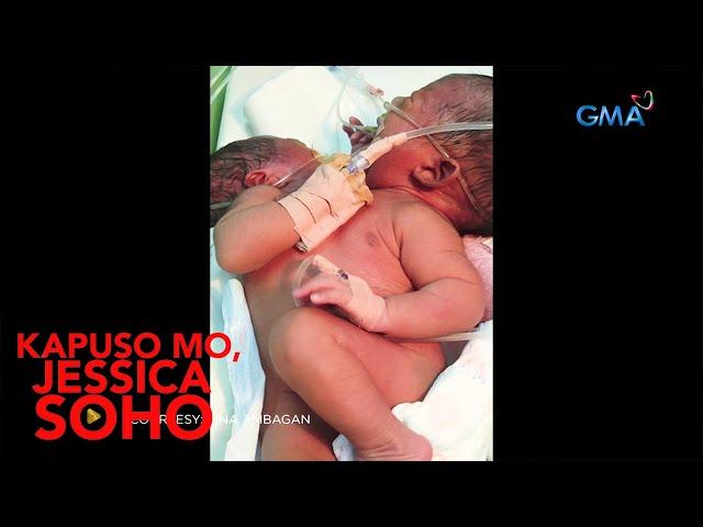 Kapuso Mo, Jessica Soho: KAMBAL SA AKLAN, ISINILANG NANG MAGKADIKIT ANG KATAWAN